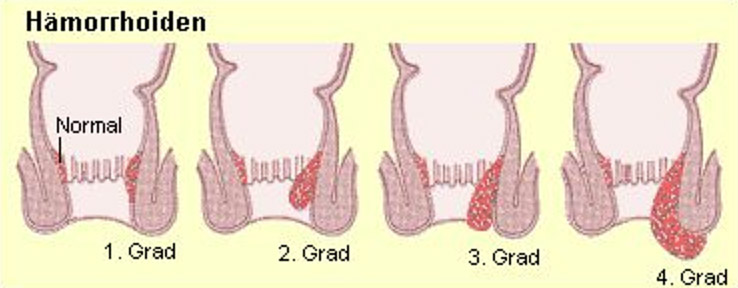 Hämorrhoiden Nach Geburt Grad 4 www.holzidoc.ch
