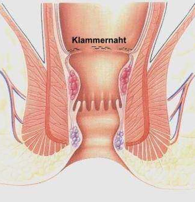Wie poslerodowoj die Hämorrhoide der fütternden Mutter zu behandeln
